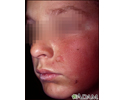 Dermatitis - contact on the cheek