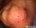 Dermatitis - herpetiformis on the knee