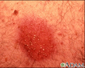 Dermatitis - pustular contact