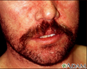 Dermatitis - seborrheic on the face