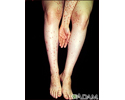Dermatitis - herpetiformis on the arm and legs