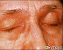 Dermatomyositis - heliotrope eyelids