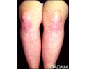 Dermatomyositis on the legs