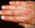 Dermatomyositis - Gottron papule