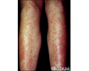 Drug rash - Tegretol