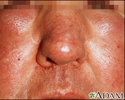 Edema - central on the face
