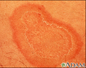 Erythema annulare centrifugum - close-up