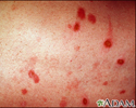 Erythema multiforme on the leg