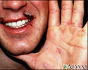 Erythema multiforme on the hand