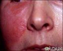 Erysipelas on the cheek