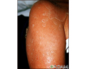 Exfoliation following erythroderma