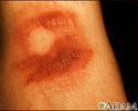 Fixed drug eruption - bullous