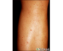 Folliculitis on the leg