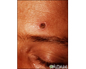 Histoplasmosis, disseminated in HIV patient