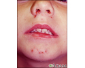 Impetigo on a child's face