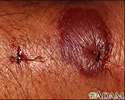 Insect bite reaction - close-up