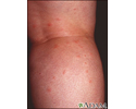 Insect bites on the legs