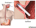 Esophageal manometry test