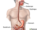 Esophagogastroduodenoscopy (EGD)
