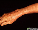 Lentigo - solar with erythema on the arm