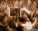 Lice, head - nits in the hair with close-up