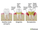 Periodontitis