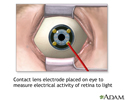 Contact lens electrode on eye