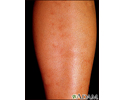 Polyarteritis - microscopic on the shin