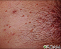 Molluscum on the chest