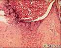 Molluscum - microscopic appearance