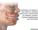 Vitamin C deficit
