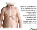 Vitamin D deficit