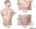 Tube feeding