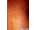 Neurofibromatosis - giant cafe-au-lait spot