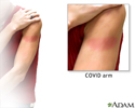 Arm Rash After COVID-19 Vaccination
