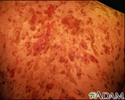 Pemphigus vulgaris on the back