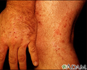 Ringworm - tinea on the hand and leg