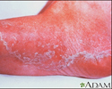 Athlete's foot - tinea pedis