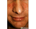 Rosacea