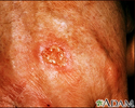 Skin cancer, squamous cell - close-up