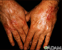 Skin cancer - squamous cell on the hands