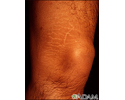 Striae on the leg