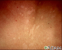 Tinea versicolor - close-up