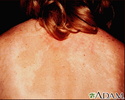 Tinea versicolor on the back