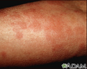 Hives (urticaria) on the arm