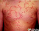 Hives (urticaria) on the chest