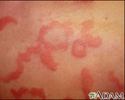 Hives (urticaria) - close-up