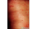 Hives (urticaria) on the trunk