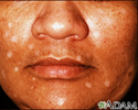 Vitiligo - drug induced