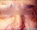 Vitiligo on the face